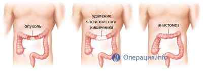 Резекція кишечника: тонкої і товстої кишки (операція видалення її частини органу)