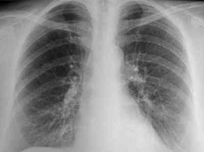 Результат флюорографії: коріння легенів розширені, малоструктурни, ущільнені
