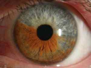 Іридоцикліт: що це таке, лікування очного захворювання, види запалення райдужної оболонки (гостре, хронічне)