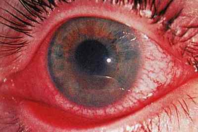 Іридоцикліт: що це таке, лікування очного захворювання, види запалення райдужної оболонки (гостре, хронічне)