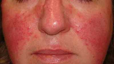 Розацеа на обличчі: симптоми, причини і лікування