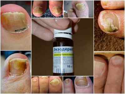 Розчин (кали, лак) Екзодерил від грибка нігтів: інструкція із застосування, ціна, відгуки, аналоги