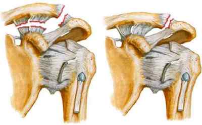 Розрив АКС плечового суглоба: симптоми і лікування, операція | Ревматолог