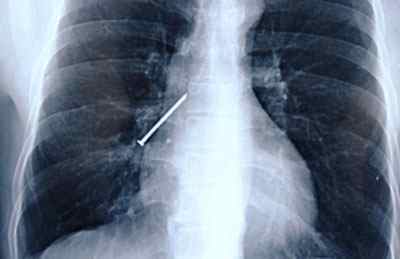 Розрив легені: причини, лікування, наслідки