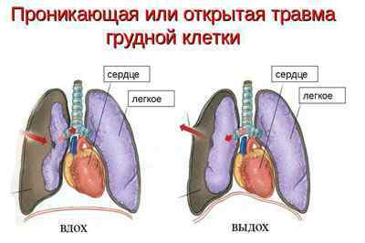 Розрив легені: причини, лікування, наслідки