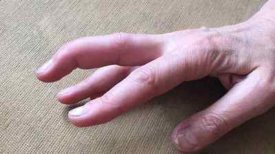 Розрив сухожилля на пальці руки: лікування травми сухожилля кисті руки, операція при пошкодженні згиначів і розгиначів | Ревматолог