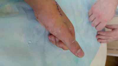 Розрив сухожилля на пальці руки: лікування травми сухожилля кисті руки, операція при пошкодженні згиначів і розгиначів | Ревматолог