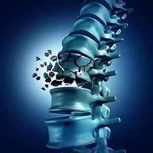 Руйнування хребців: причини деструкції поперекового відділу, руйнування шийного хребця і хрящової тканини на рентгені | Ревматолог