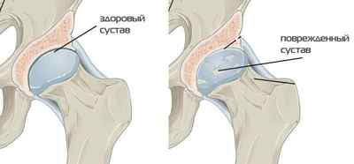 Руйнування тазостегнового і колінного суглоба: симптоми і лікування зносу кістки, ознаки | Ревматолог