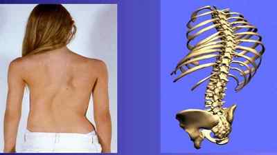 S-подібне викривлення хребта 1 і 2 ступеня: лікування s-образного сколіозу грудного відділу, вправи, ЛФК | Ревматолог
