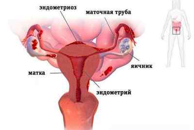 СA 125 при ендометріозі: норма у жінок