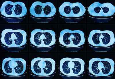 Що краще МРТ або КТ легенів і бронхів
