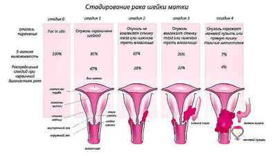 Що лежить в основі причин раку шийки матки - РШМ