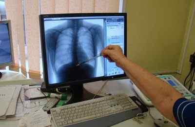 Що означає посилення легеневого малюнка на флюорографії