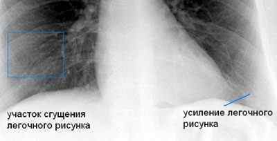 Що означає посилення легеневого малюнка на флюорографії