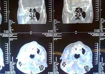 Що показує КТ і МРТ горла і гортані