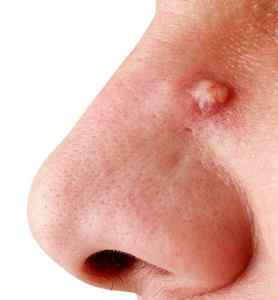 Що робити, якщо схопився фурункул в носі або на переніссі, як можна позбутися від недуги?