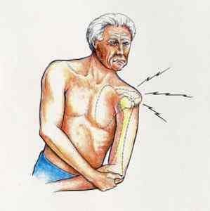 Що робити якщо вилітає плече з суглоба: лікування випадіння плечового суглоба | Ревматолог