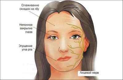 Онемевает правая сторона лица. Невралгия тройничного нерва симптомы. Целый день онемевшая часть лица. Почему долго болит ухо при лицевом неврите.