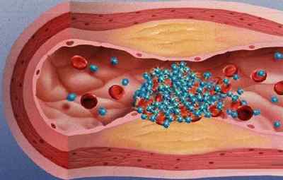 Що таке агрегація тромбоцитів в аналізі крові