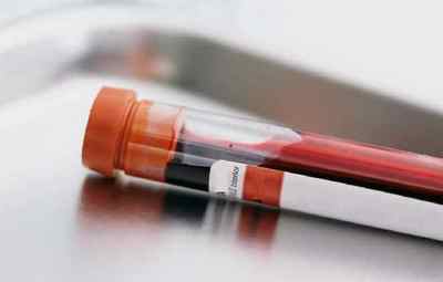 Що таке аналіз крові ПЛР і як здавати