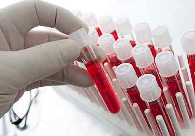 Що таке аналіз крові РМП на сифіліс