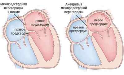 Що таке аневризма аорти серця і симптоми після інфаркту міокарда