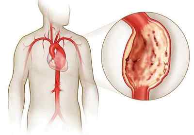 Що таке аневризма висхідної аорти і симптоми