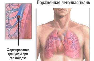 Що таке біопсія легень і як її роблять