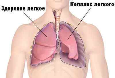 Що таке біопсія легень і як її роблять