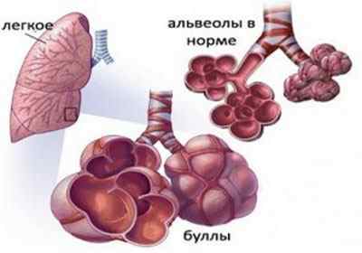 Що таке буллезная хвороба легенів, її симптоми і лікування