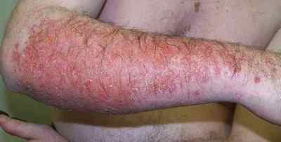 Що таке дерматит шкіри: причини, як вилікувати?