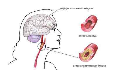 Що таке дисциркуляторна енцефалопатія 1 і 2 ступеня