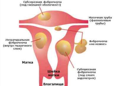 Що таке фіброміома матки, симптоми і ознаки