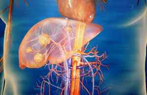 Що таке фокальна неодулярная гіперплазія печінки і як лікується