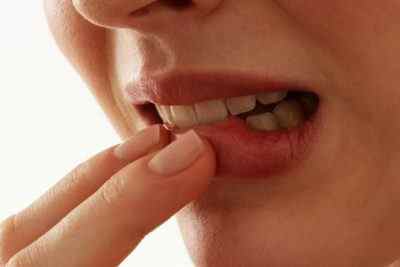 Що таке фурункул на губі, через що виникає, що відомо про способи лікування і як чиряк виглядає на фото?