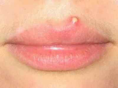 Що таке фурункул на губі, через що виникає, що відомо про способи лікування і як чиряк виглядає на фото?
