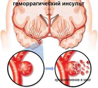 Що таке геморагічний інсульт або крововилив в мозок і наслідки захворювання