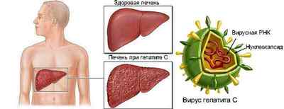 Що таке гепатит С: особливості захворювання, симптоми, методи діагностики і лікування
