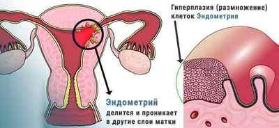 Що таке гіперплазія ендометрію, як її діагностувати і лікувати