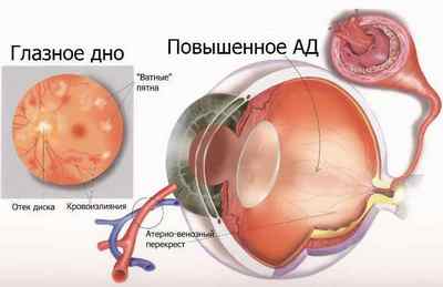 Що таке гіпертонічна ангіопатія сітківки ока
