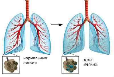 Що таке гіповентиляція легень