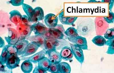 Що таке хламідія трахоматіс виявлена в аналізах