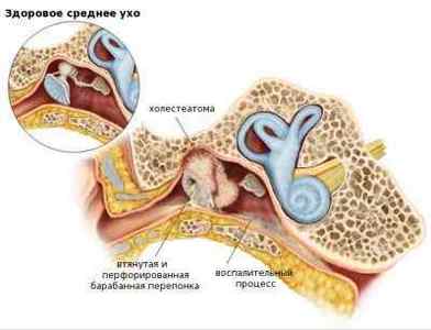 Що таке холестеатома вуха, її симптоми і лікування