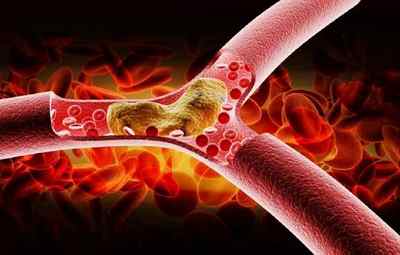 Що таке холестерин ЛПВЩ в біохімічному аналізі крові