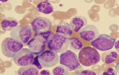 Що таке хронічний лімфоцитарний лейкоз