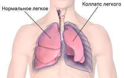 Що таке колапс легені, його симптоми і лікування