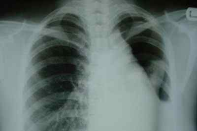 Що таке колапс легені, його симптоми і лікування