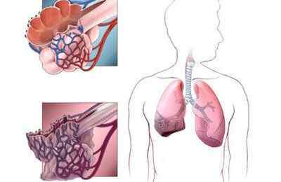 Що таке крепітація в легенях