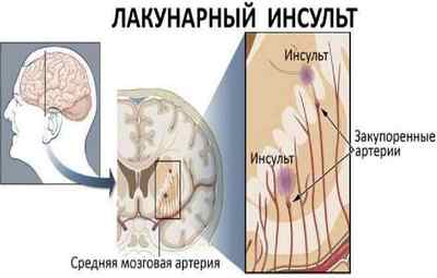 Що таке лакунарний ішемічний інсульт головного мозку
